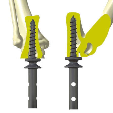 bio3Dvet_Veterinary_ITAP_Implant_Artificial Limb_Bionic Cat_Bioengineering_Advanced Veterinary Services_Custom Made Titanium Implant_Hydroxyapatite Coating_Perseus_Perseas_3D Printing_Περσέας_Κτηνιατρική_Βιονική Γάτα_Ενδομυελικό Εμφύτευμα_Τεχνητό Άκρο_Εμβιομηχανική_Προηγμένες Κτηνιατρικές Υπηρεσίες_Εξατομικευμένο Εμφύτευμα Τιτανίου_Επικάλυψη Υδροξυαπατίτη_Τρισδιάστατη Εκτύπωση_Ι2