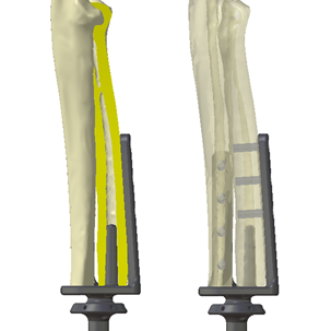 bio3Dvet_Veterinary_ITAP_Implant_Artificial Limb_Bionic Cat_Bioengineering_Advanced Veterinary Services_Custom Made Titanium Implant_Hydroxyapatite Coating_Perseus_Perseas_3D Printing_Περσέας_Κτηνιατρική_Βιονική Γάτα_Ενδομυελικό Εμφύτευμα_Τεχνητό Άκρο_Εμβιομηχανική_Προηγμένες Κτηνιατρικές Υπηρεσίες_Εξατομικευμένο Εμφύτευμα Τιτανίου_Επικάλυψη Υδροξυαπατίτη_Τρισδιάστατη Εκτύπωση_Ι1