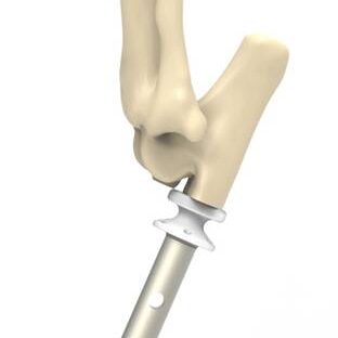 bio3Dvet_Veterinary_ITAP_Implant_Artificial Limb_Bionic Cat_Bioengineering_Advanced Veterinary Services_3D Printing _Custom Made Titanium Implant_Hydroxyapatite Coating_Κτηνιατρική_Βιονική Γάτα_Ενδομυελικό Εμφύτευμα_Περσέας_Τεχνητό Άκρο_Perseas_Perseus_Εμβιομηχανική_Προηγμένες Κτηνιατρικές Υπηρεσίες_Τρισδιάστατη Εκτύπωση_Εξατομικευμένο Εμφύτευμα Τιτανίου_Επικάλυψη Υδροξυαπατίτη_Ι5