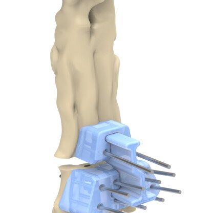 bio3Dvet_Veterinary_Custom Made Surgical Guides_3D Printing_Bioengineering_Advanced Veterinary Services_Κτηνιατρική_Εξατομικευμένοι Χειρουργικοί Οδηγοί_Τρισδιάστατη Εκτύπωση_Εμβιομηχανική_Προηγμένες Κτηνιατρικές Υπηρεσίες_I15