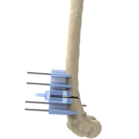 bio3Dvet_Veterinary_Custom Made Surgical Guides_3D Printing_Bioengineering_Advanced Veterinary Services_Κτηνιατρική_Εξατομικευμένοι Χειρουργικοί Οδηγοί_Τρισδιάστατη Εκτύπωση_Εμβιομηχανική_Προηγμένες Κτηνιατρικές Υπηρεσίες_I6