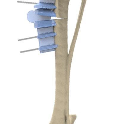 bio3Dvet_Veterinary_Custom Made Surgical Guides_3D Printing_Bioengineering_Advanced Veterinary Services_Κτηνιατρική_Εξατομικευμένοι Χειρουργικοί Οδηγοί_Τρισδιάστατη Εκτύπωση_Εμβιομηχανική_Προηγμένες Κτηνιατρικές Υπηρεσίες_I9