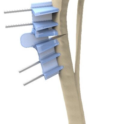 bio3Dvet_Veterinary_Custom Made Surgical Guides_3D Printing_Bioengineering_Advanced Veterinary Services_Κτηνιατρική_Εξατομικευμένοι Χειρουργικοί Οδηγοί_Τρισδιάστατη Εκτύπωση_Εμβιομηχανική_Προηγμένες Κτηνιατρικές Υπηρεσίες_I11